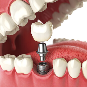 illustration of a dental implant