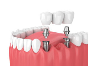 dental bridge fairfax va