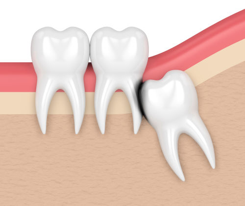 teeth extraction fairfax va