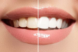 teeth whitening fairfax va