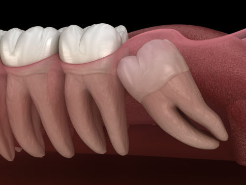 wisdom teeth fairfax Va