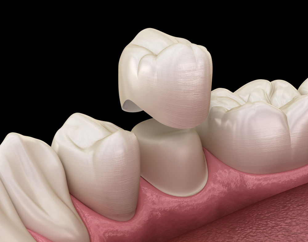 dental crowns fairfax va